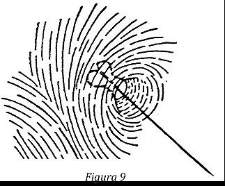 Botridia posterior en forma de globo